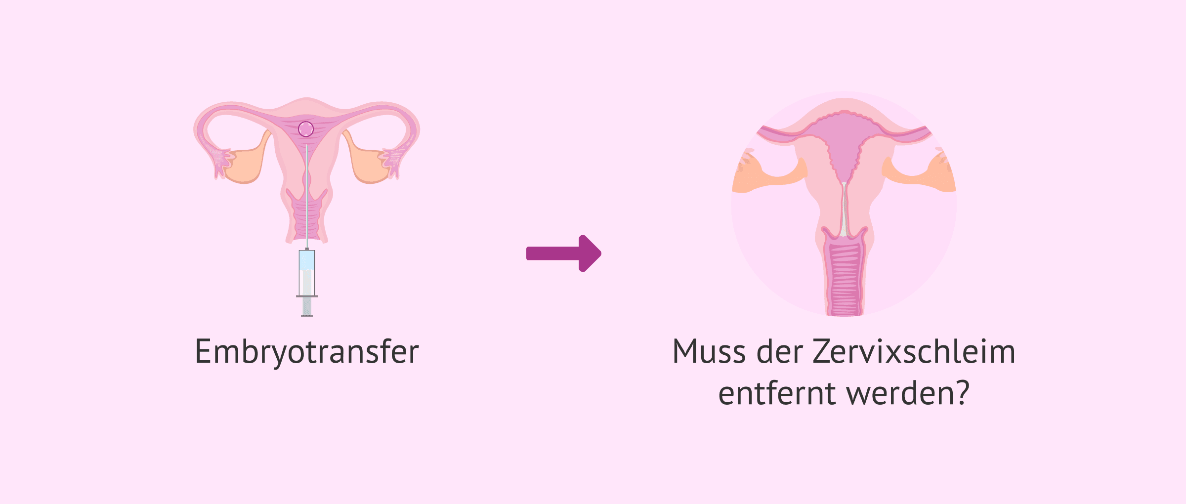 Zervixschleim bei IVF entfernen: Warum dieser medizinische Schritt überflüssig ist