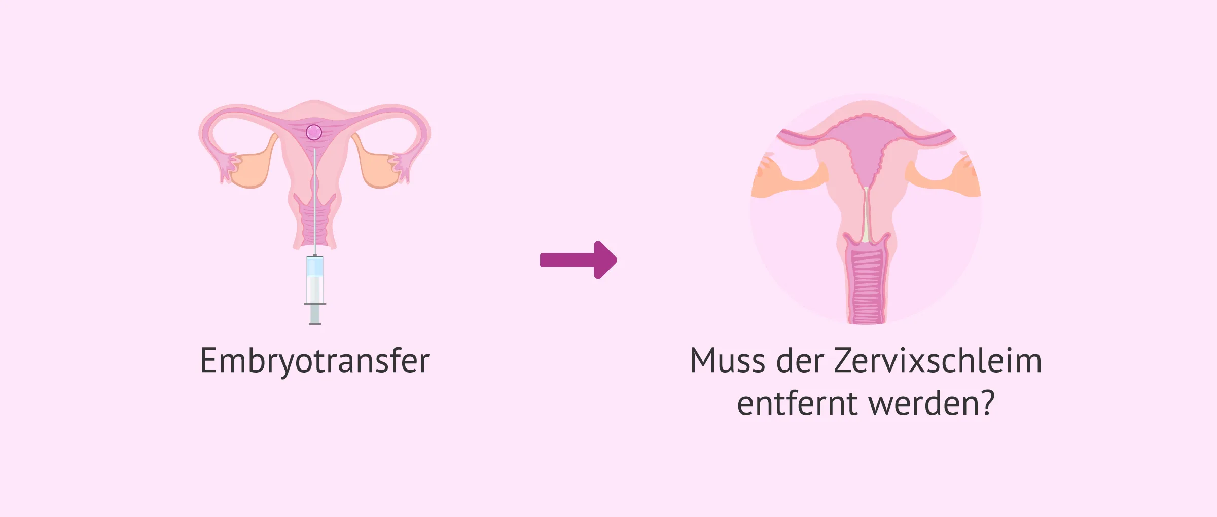 Zervixschleim bei IVF entfernen: Warum dieser medizinische Schritt überflüssig ist
