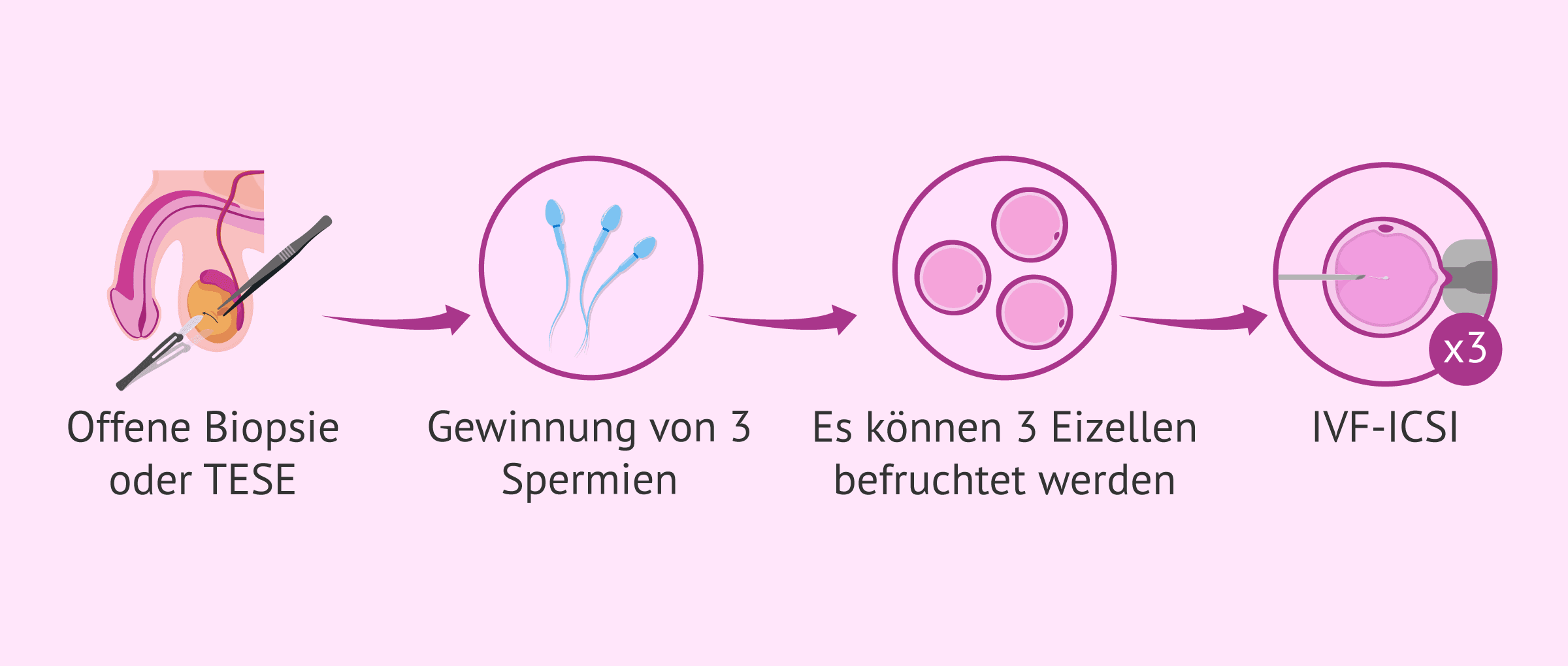 Imagen: Hodenbiopsie und ICSI zur Erzielung einer Schwangerschaft
