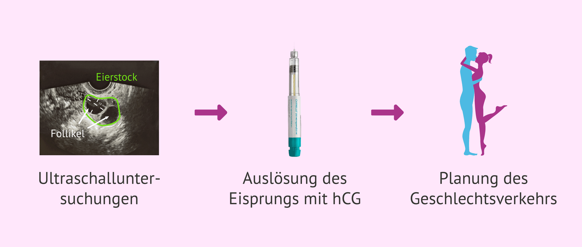 Imagen: Geplanter Geschlechtsverkehr bei Frauen mit PCOS