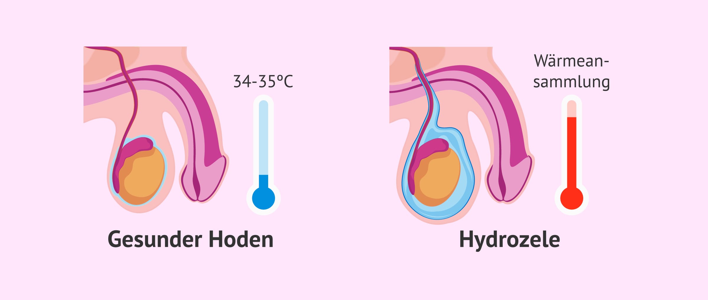 Imagen: Hydrozele und Hodentemperatur