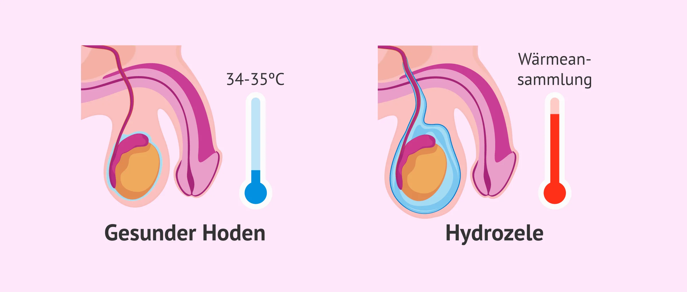 Medizinischer Mythos: Beeinflusst eine Hydrozele die männliche Fruchtbarkeit oder nicht?
