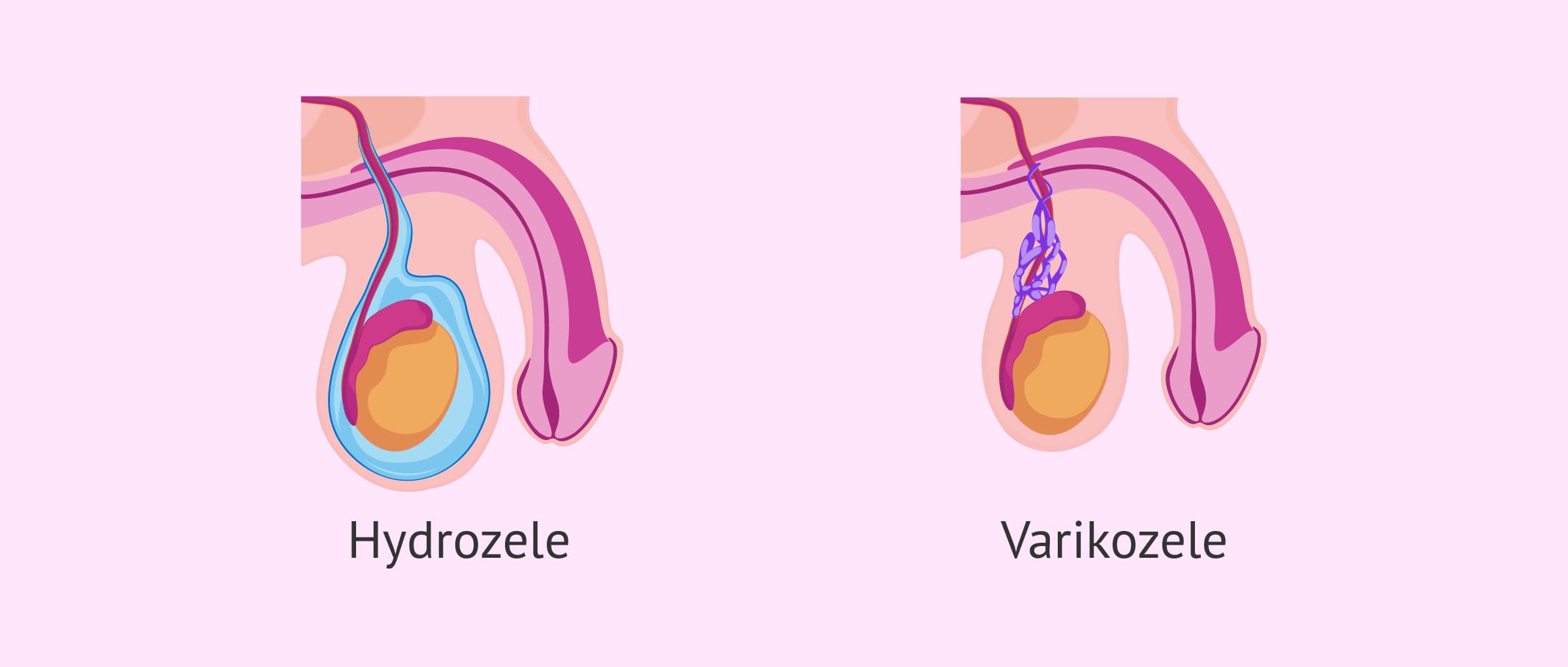 Imagen: Unterschiede zwischen Hydrozele und Varikozele