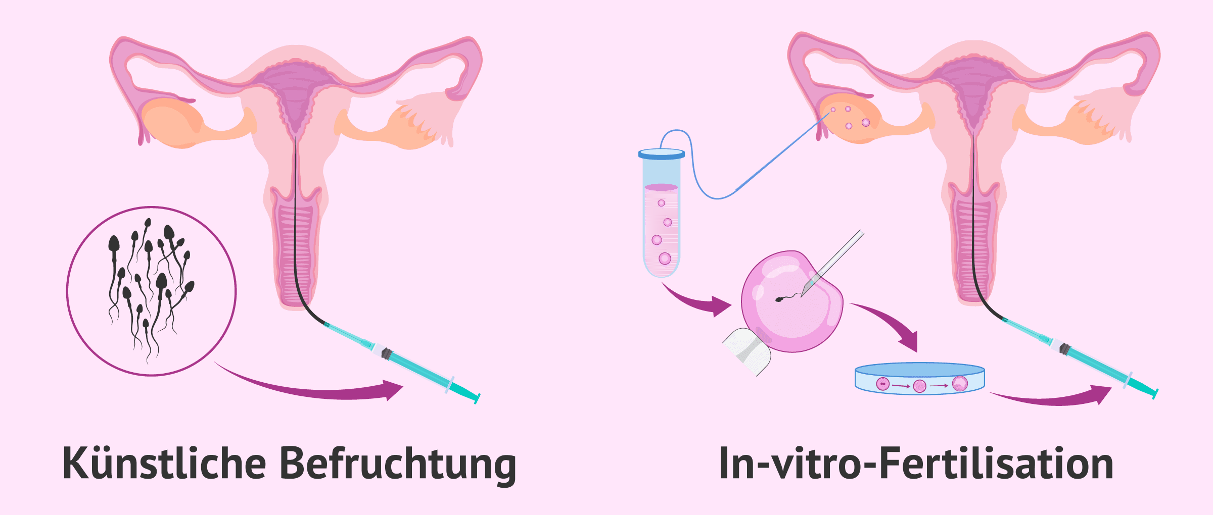 Schwangerschaft mit dem polyzystischen Ovarialsyndrom (PCOS)
