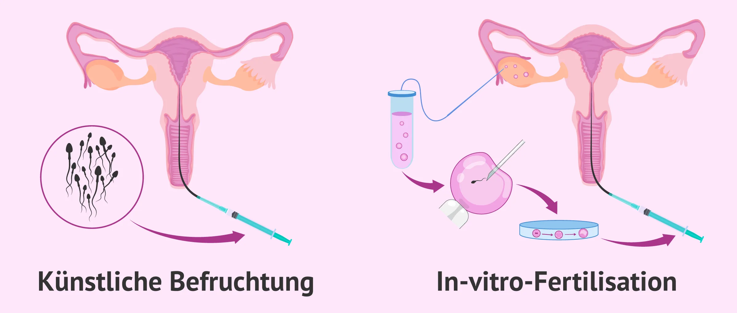 Schwangerschaft mit dem polyzystischen Ovarialsyndrom (PCOS)
