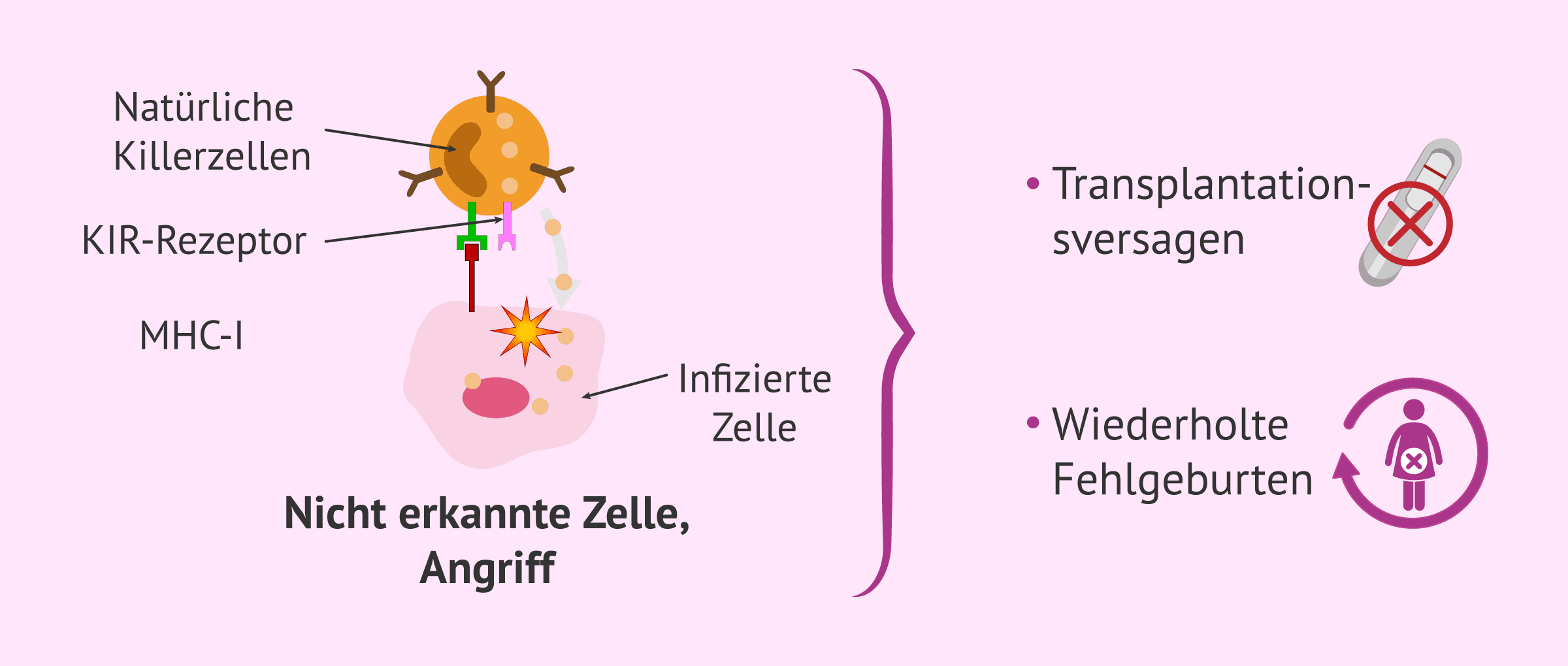 Imagen: Alloimmunbedingte Unfruchtbarkeit durch erhöhte NK-Zellen