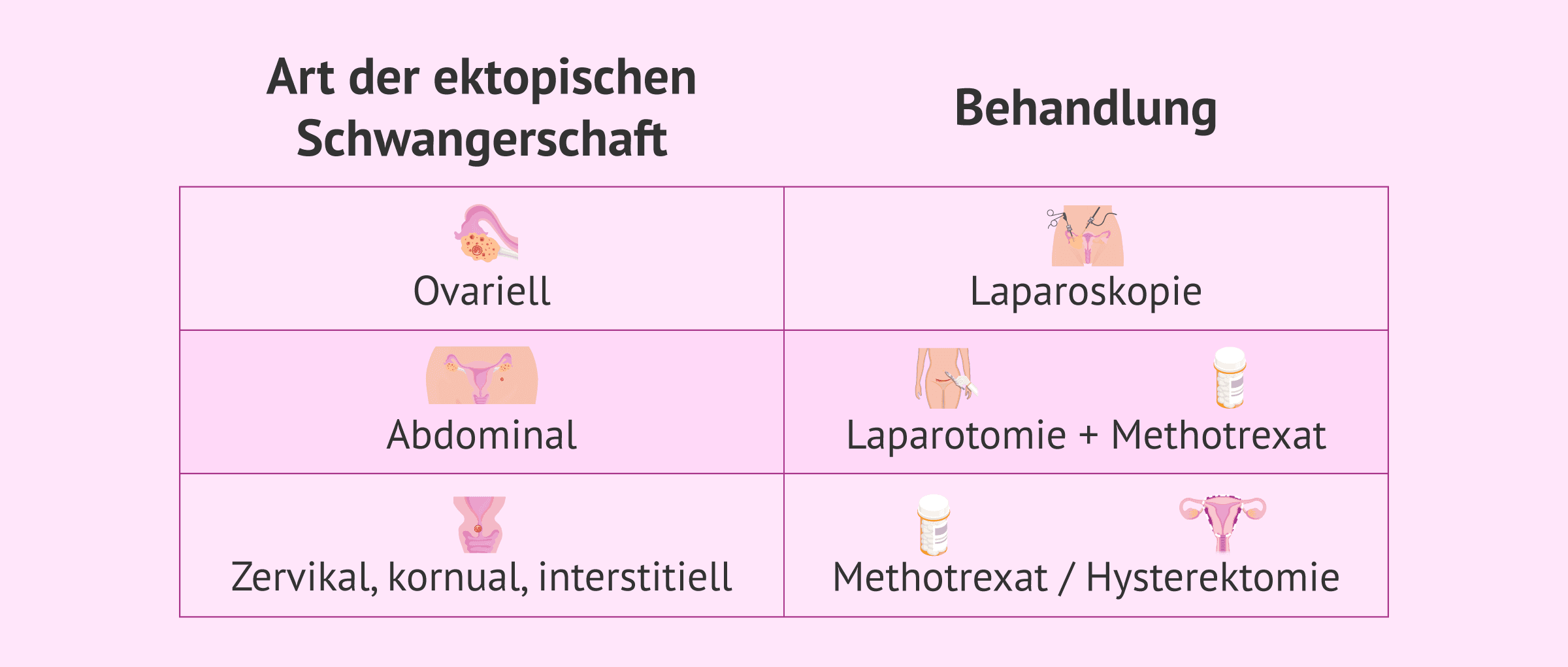 Imagen: Behandlung je nach Art der ektopischen Schwangerschaft