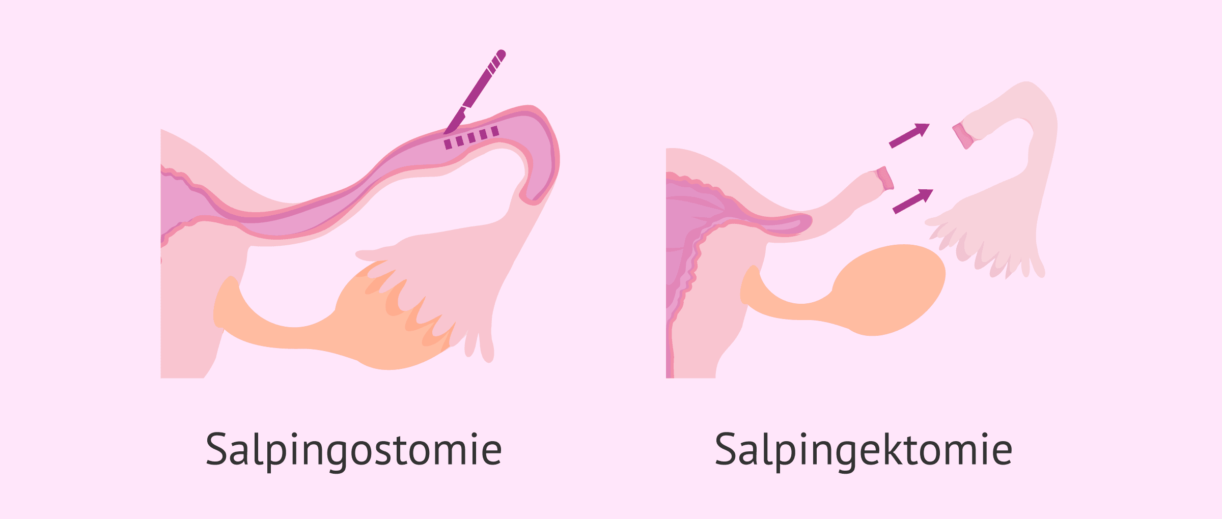 Imagen: Salpingostomie und Salpingektomie zur Behandlung einer ektopischen Schwangerschaft