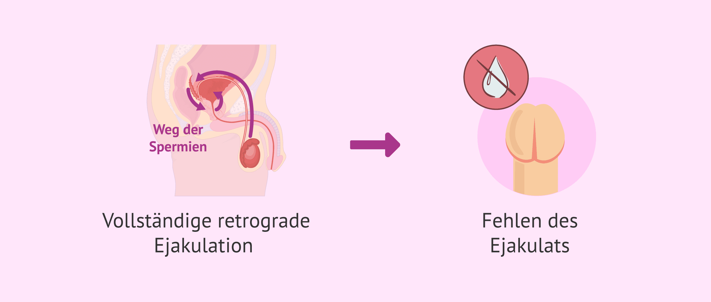 Imagen: Folgen der kompletten retrograden Ejakulation