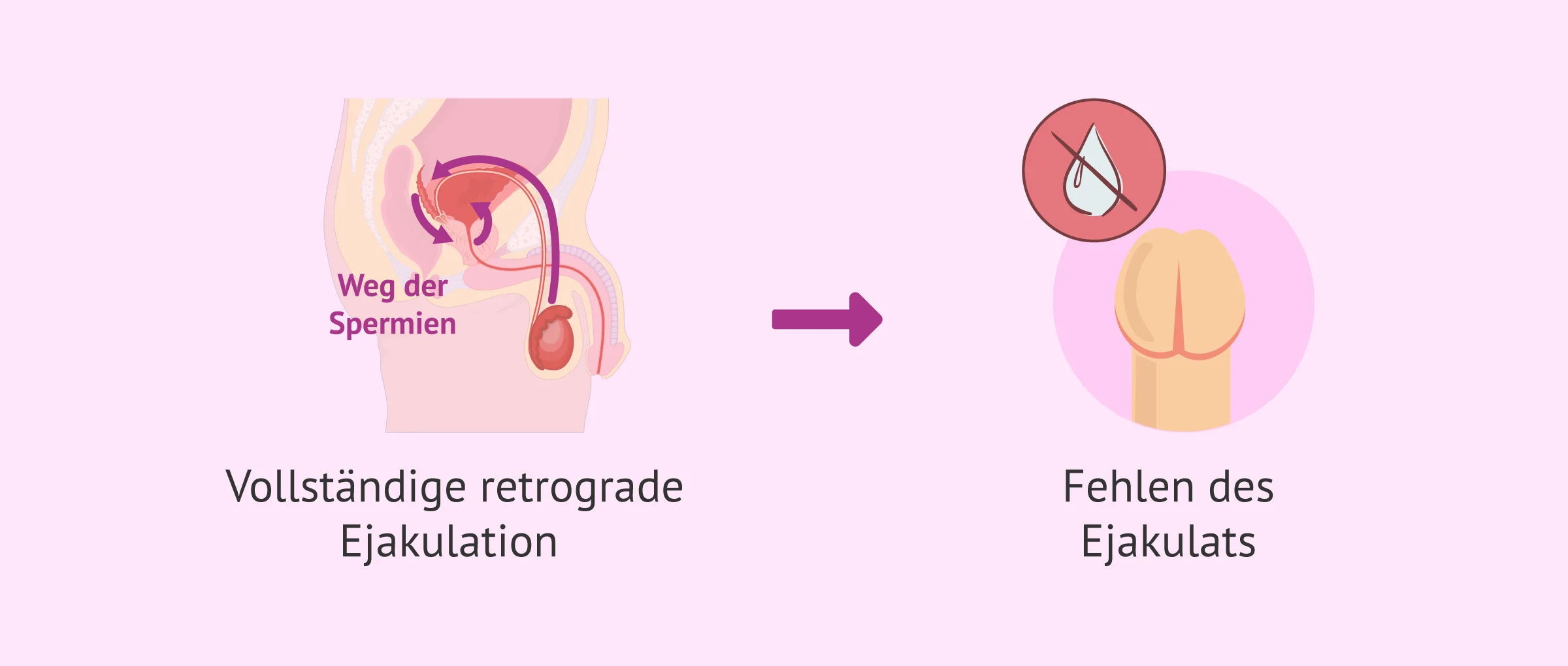 Folgen der kompletten retrograden Ejakulation