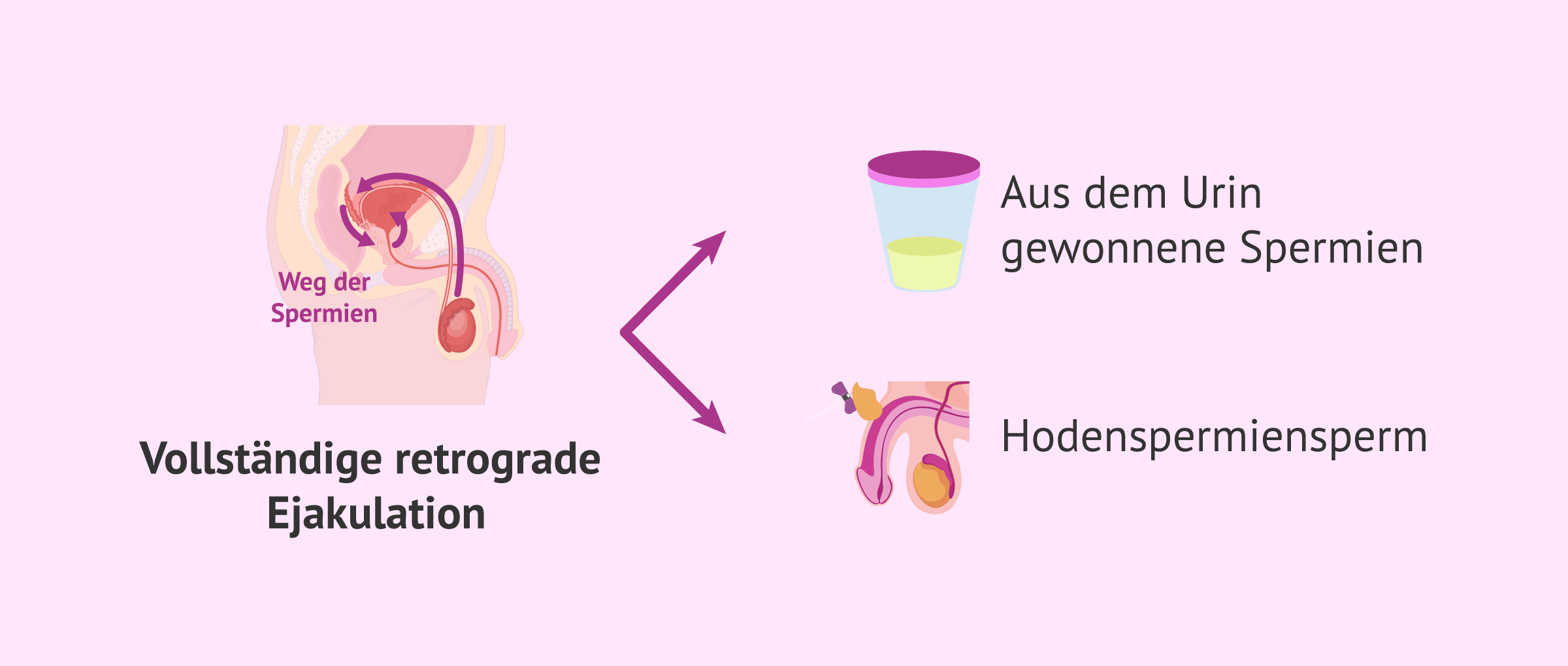 IVF bei retrograder Ejakulation: das Geheimnis einer erfolgreichen Schwangerschaft