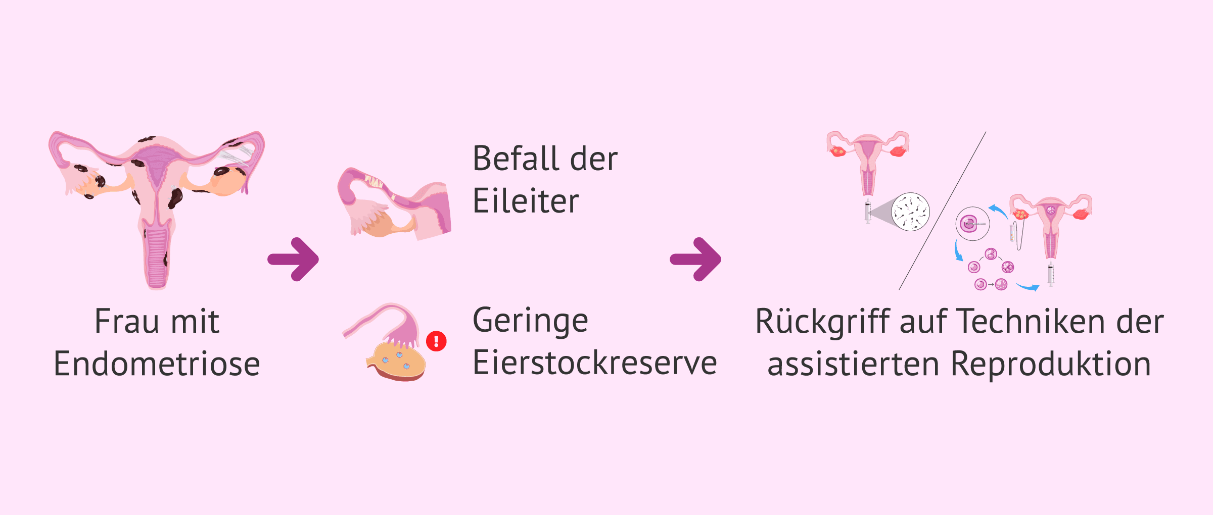Imagen: Auswirkungen von Endometriose auf die Fruchtbarkeit