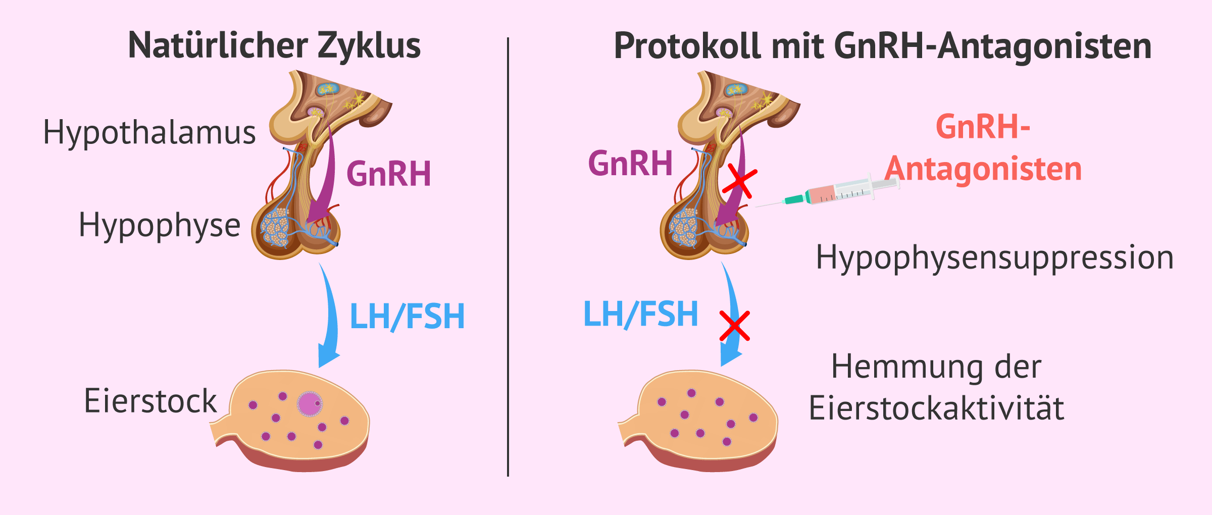 Was ist ein kurzes IVF-Protokoll mit GnRH-Antagonisten?
